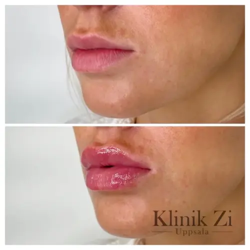 Fillers-lappar-12.jpg